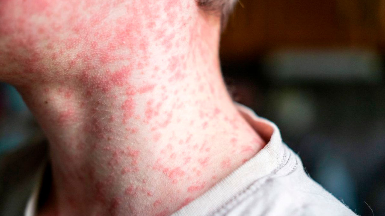 Fresnillo bajo vigilancia epidemiológica por brote de sarampión y tosferina